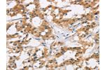 The image is immunohistochemistry of paraffin-embedded Human thyroid cancer tissue using CSB-PA917071(AXIN2 Antibody) at dilution 1/20. (Original magnification: 