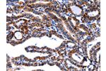 The image on the left is immunohistochemistry of paraffin-embedded Human thyroid cancer tissue using CSB-PA917144(FBN1 Antibody) at dilution 1/40, on the right is treated with synthetic peptide. (Original magnification: 