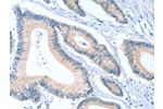 The image on the left is immunohistochemistry of paraffin-embedded Human colon cancer tissue using CSB-PA917188(ACTL7B Antibody) at dilution 1/20, on the right is treated with fusion protein. (Original magnification: 