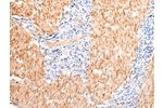 The image on the left is immunohistochemistry of paraffin-embedded Human gastric cancer tissue using CSB-PA917278(DMBT1 Antibody) at dilution 1/20, on the right is treated with synthetic peptide. (Original magnification: 