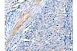 The image on the left is immunohistochemistry of paraffin-embedded Human cervical cancer tissue using CSB-PA917287(ACTRT1 Antibody) at dilution 1/15, on the right is treated with fusion protein. (Original magnification: 