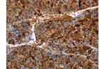 The image on the left is immunohistochemistry of paraffin-embedded Human liver cancer tissue using CSB-PA918257(AKR1B10 Antibody) at dilution 1/30, on the right is treated with fusion protein. (Original magnification: 