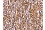 The image on the left is immunohistochemistry of paraffin-embedded Human gastic cancer tissue using CSB-PA918886(AMER1 Antibody) at dilution 1/40, on the right is treated with synthetic peptide. (Original magnification: 