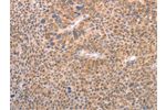 The image on the left is immunohistochemistry of paraffin-embedded Human liver cancer tissue using CSB-PA919003(AASDHPPT Antibody) at dilution 1/30, on the right is treated with fusion protein. (Original magnification: 
