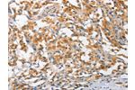 The image on the left is immunohistochemistry of paraffin-embedded Human thyroid cancer tissue using CSB-PA919511(ARL8A Antibody) at dilution 1/25, on the right is treated with fusion protein. (Original magnification: 