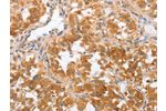 The image on the left is immunohistochemistry of paraffin-embedded Human thyroid cancer tissue using CSB-PA919659(CRELD2 Antibody) at dilution 1/50, on the right is treated with fusion protein. (Original magnification: 