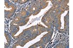 The image on the left is immunohistochemistry of paraffin-embedded Human cervical cancer tissue using CSB-PA919793(DEFA1 Antibody) at dilution 1/10, on the right is treated with fusion protein. (Original magnification: 
