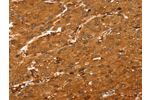 The image on the left is immunohistochemistry of paraffin-embedded Human liver cancer tissue using CSB-PA920347(ABCC9 Antibody) at dilution 1/35, on the right is treated with synthetic peptide. (Original magnification: 