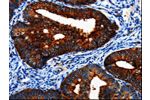 The image on the left is immunohistochemistry of paraffin-embedded Human cervical cancer tissue using CSB-PA920513(BIRC6 Antibody) at dilution 1/7, on the right is treated with synthetic peptide. (Original magnification: 