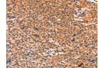 The image on the left is immunohistochemistry of paraffin-embedded Human liver cancer tissue using CSB-PA920990(AMPD1 Antibody) at dilution 1/80, on the right is treated with synthetic peptide. (Original magnification: 