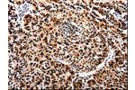 The image on the left is immunohistochemistry of paraffin-embedded Human lung cancer tissue using CSB-PA921015(APIP Antibody) at dilution 1/25, on the right is treated with fusion protein. (Original magnification: 