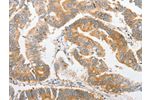 The image on the left is immunohistochemistry of paraffin-embedded Human colon cancer tissue using CSB-PA921124(ALPI Antibody) at dilution 1/25, on the right is treated with fusion protein. (Original magnification: 