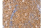 The image on the left is immunohistochemistry of paraffin-embedded Human ovarian cancer tissue using CSB-PA921264(DUSP4 Antibody) at dilution 1/30, on the right is treated with fusion protein. (Original magnification: 