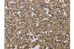 The image on the left is immunohistochemistry of paraffin-embedded Human thyroid cancer tissue using CSB-PA921442(DCTN3 Antibody) at dilution 1/50, on the right is treated with fusion protein. (Original magnification: 