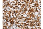 The image on the left is immunohistochemistry of paraffin-embedded Human thyroid cancer tissue using CSB-PA921679(DSP Antibody) at dilution 1/40, on the right is treated with synthetic peptide. (Original magnification: 