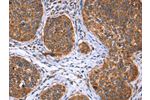 The image on the left is immunohistochemistry of paraffin-embedded Human cervical cancer tissue using CSB-PA921718(EVC2 Antibody) at dilution 1/40, on the right is treated with synthetic peptide. (Original magnification: 