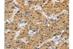 The image on the left is immunohistochemistry of paraffin-embedded Human liver cancer tissue using CSB-PA921825(BTLA Antibody) at dilution 1/30, on the right is treated with fusion protein. (Original magnification: 