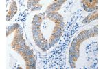The image on the left is immunohistochemistry of paraffin-embedded Human colon cancer tissue using CSB-PA922061(DAP3 Antibody) at dilution 1/15, on the right is treated with fusion protein. (Original magnification: 
