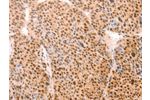 The image on the left is immunohistochemistry of paraffin-embedded Human liver cancer tissue using CSB-PA922317(ALYREF Antibody) at dilution 1/15, on the right is treated with synthetic peptide. (Original magnification: 