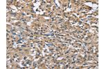 The image on the left is immunohistochemistry of paraffin-embedded Human thyroid cancer tissue using CSB-PA922469(FLT3 Antibody) at dilution 1/30, on the right is treated with fusion protein. (Original magnification: 