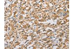 The image on the left is immunohistochemistry of paraffin-embedded Human thyroid cancer tissue using CSB-PA923194(ARHGAP5 Antibody) at dilution 1/25, on the right is treated with fusion protein. (Original magnification: 
