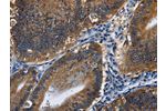 The image on the left is immunohistochemistry of paraffin-embedded Human colon cancer tissue using CSB-PA923298(CD46 Antibody) at dilution 1/30, on the right is treated with fusion protein. (Original magnification: 