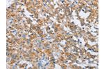 The image on the left is immunohistochemistry of paraffin-embedded Human thyroid cancer tissue using CSB-PA923334(FOXF2 Antibody) at dilution 1/30, on the right is treated with synthetic peptide. (Original magnification: 