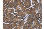 The image on the left is immunohistochemistry of paraffin-embedded Human ovarian cancer tissue using CSB-PA923404(GAB2 Antibody) at dilution 1/50, on the right is treated with fusion protein. (Original magnification: 