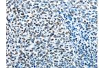 The image on the left is immunohistochemistry of paraffin-embedded Human ovarian cancer tissue using CSB-PA923713(CREB1 Antibody) at dilution 1/15, on the right is treated with fusion protein. (Original magnification: 