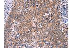 The image on the left is immunohistochemistry of paraffin-embedded Human cervical cancer tissue using CSB-PA924161(EDN1 Antibody) at dilution 1/50, on the right is treated with fusion protein. (Original magnification: 
