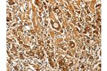 The image on the left is immunohistochemistry of paraffin-embedded Human gastic cancer tissue using CSB-PA924165(FSHR Antibody) at dilution 1/70, on the right is treated with fusion protein. (Original magnification: 