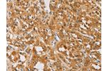The image on the left is immunohistochemistry of paraffin-embedded Human thyroid cancer tissue using CSB-PA924465(ATG4D Antibody) at dilution 1/40, on the right is treated with fusion protein. (Original magnification: 