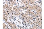 The image on the left is immunohistochemistry of paraffin-embedded Human lung cancer tissue using CSB-PA924477(CDC34 Antibody) at dilution 1/40, on the right is treated with synthetic peptide. (Original magnification: 