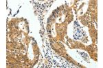 The image on the left is immunohistochemistry of paraffin-embedded Human colon cancer tissue using CSB-PA924854(CDH23 Antibody) at dilution 1/60, on the right is treated with fusion protein. (Original magnification: 