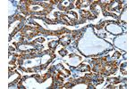 The image on the left is immunohistochemistry of paraffin-embedded Human thyroid cancer tissue using CSB-PA925196(ALDH6A1 Antibody) at dilution 1/45, on the right is treated with fusion protein. (Original magnification: 