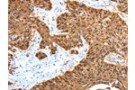 The image on the left is immunohistochemistry of paraffin-embedded Human esophagus cancer tissue using CSB-PA925454(ADAMTS5 Antibody) at dilution 1/30, on the right is treated with synthetic peptide. (Original magnification: 
