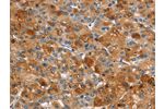 The image on the left is immunohistochemistry of paraffin-embedded Human liver cancer tissue using CSB-PA925886(ARPC2 Antibody) at dilution 1/30, on the right is treated with synthetic peptide. (Original magnification: 