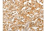 The image on the left is immunohistochemistry of paraffin-embedded Human thyroid cancer tissue using CSB-PA926103(APTX Antibody) at dilution 1/50, on the right is treated with fusion protein. (Original magnification: 
