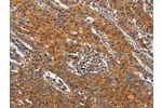 The image on the left is immunohistochemistry of paraffin-embedded Human gastic cancer tissue using CSB-PA926374(BLK Antibody) at dilution 1/20, on the right is treated with fusion protein. (Original magnification: 