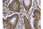 The image on the left is immunohistochemistry of paraffin-embedded Human colon cancer tissue using CSB-PA926721(FGFRL1 Antibody) at dilution 1/20, on the right is treated with fusion protein. (Original magnification: 