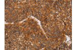 The image on the left is immunohistochemistry of paraffin-embedded Human liver cancer tissue using CSB-PA926996(CD38 Antibody) at dilution 1/60, on the right is treated with synthetic peptide. (Original magnification: 