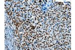 The image on the left is immunohistochemistry of paraffin-embedded Human cervical cancer tissue using CSB-PA927573(CREB1 Antibody) at dilution 1/30, on the right is treated with fusion protein. (Original magnification: 
