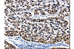 The image on the left is immunohistochemistry of paraffin-embedded Human lung cancer tissue using CSB-PA928455(AP1B1 Antibody) at dilution 1/25, on the right is treated with synthetic peptide. (Original magnification: 