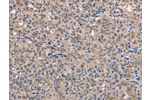 The image on the left is immunohistochemistry of paraffin-embedded Human thyroid cancer tissue using CSB-PA928634(FOXO1  Antibody) at dilution 1/30, on the right is treated with synthetic peptide. (Original magnification: 