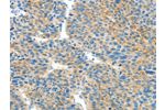 The image on the left is immunohistochemistry of paraffin-embedded Human liver cancer tissue using CSB-PA928784(BCAT1 Antibody) at dilution 1/50, on the right is treated with fusion protein. (Original magnification: 