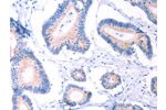 The image on the left is immunohistochemistry of paraffin-embedded Human colon cancer tissue using CSB-PA928876(AADAC Antibody) at dilution 1/30, on the right is treated with fusion protein. (Original magnification: 