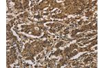 The image on the left is immunohistochemistry of paraffin-embedded Human gastic cancer tissue using CSB-PA929092(DUSP23 Antibody) at dilution 1/20, on the right is treated with fusion protein. (Original magnification: 