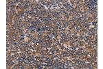 The image on the left is immunohistochemistry of paraffin-embedded Human lymphoma tissue using CSB-PA929212(ALG9 Antibody) at dilution 1/30, on the right is treated with fusion protein. (Original magnification: 
