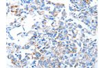 The image on the left is immunohistochemistry of paraffin-embedded Human breast cancer tissue using CSB-PA929439(ALAS1 Antibody) at dilution 1/30, on the right is treated with fusion protein. (Original magnification: 
