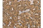 The image on the left is immunohistochemistry of paraffin-embedded Human liver cancer tissue using CSB-PA929748(ENTPD5 Antibody) at dilution 1/20, on the right is treated with fusion protein. (Original magnification: 